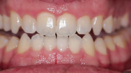 Before and After Images Dentist Abbotsford VIC 3067, Australia