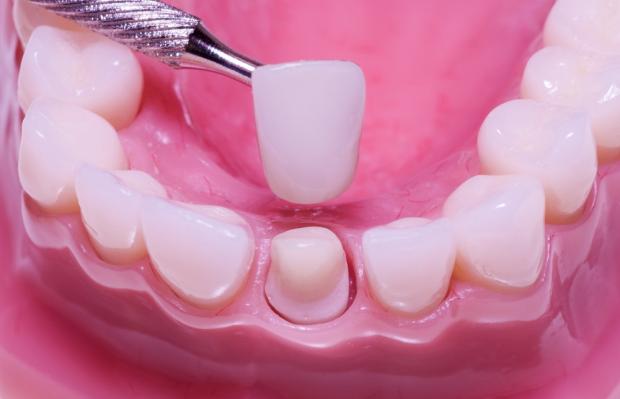 dental crown | Dentist Abbotsford