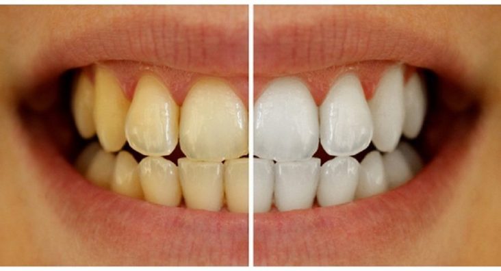 Do you need teeth cleaning? Yellow teeth | Abbotsford Dental before and after images