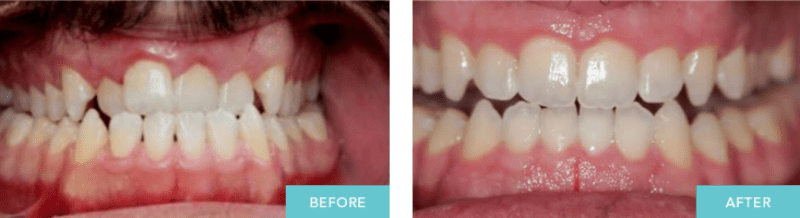 Dentist Abbotsford before and after pictures