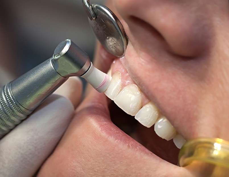Checkup and Clean Abbotsford Dental
