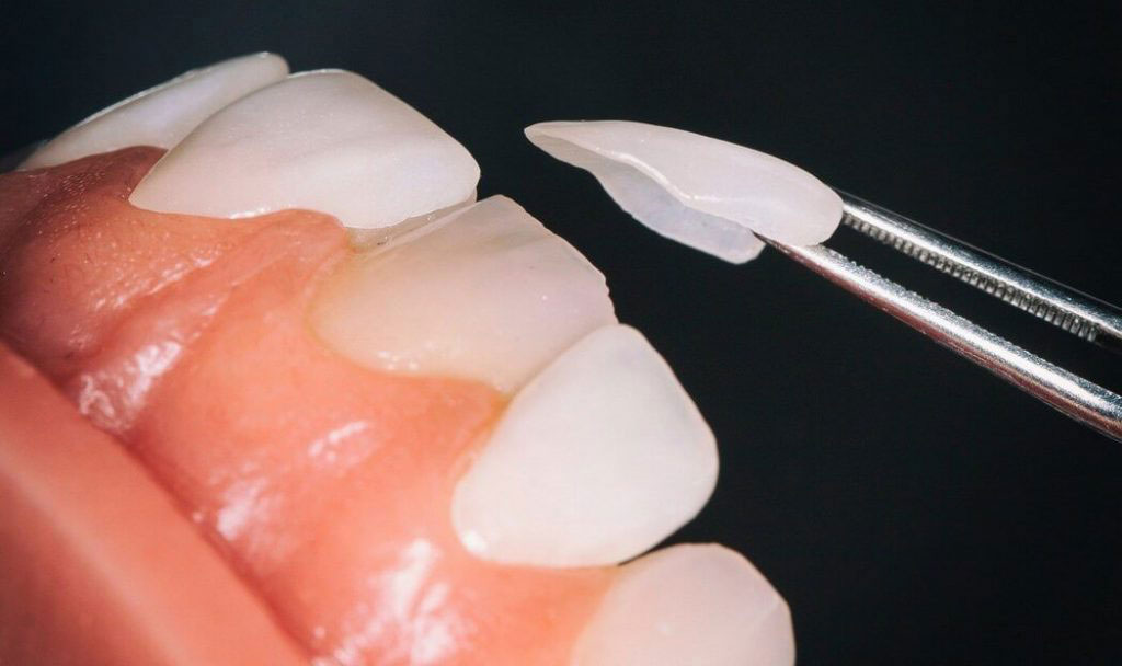 Dental Veneers | Dentist Abbotsford
