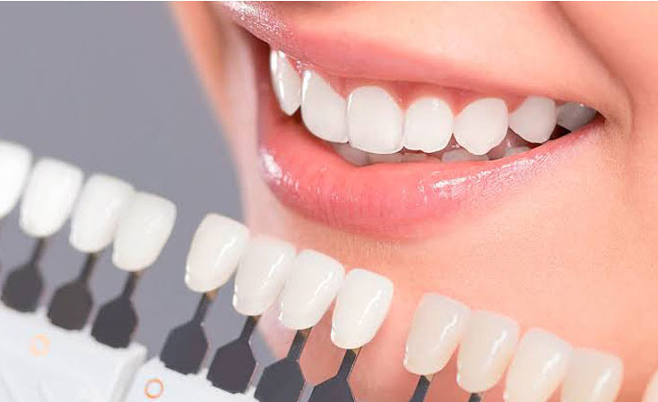 Veneers-Porcelain Dental Service