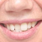 Are Your Teeth Crooked?