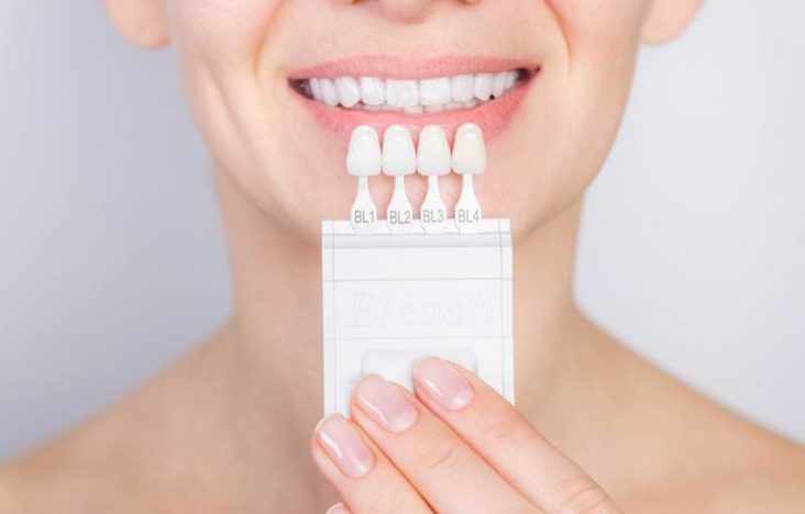 Dental Veneer Treatment
