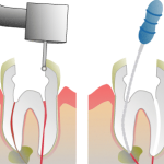 Root Canal Molar