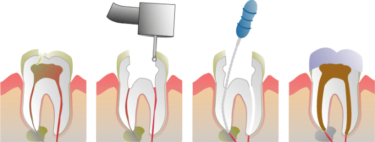 Root Canal Molar