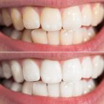 Teeth Whitening Richmond-Kew
