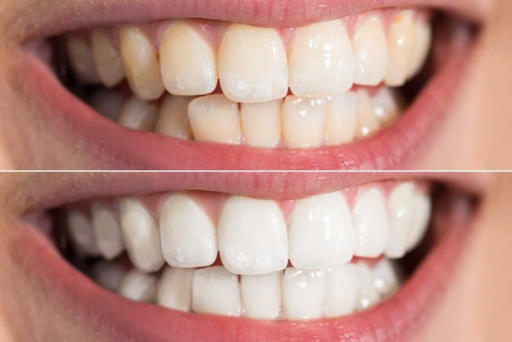 Teeth Whitening Richmond-Kew